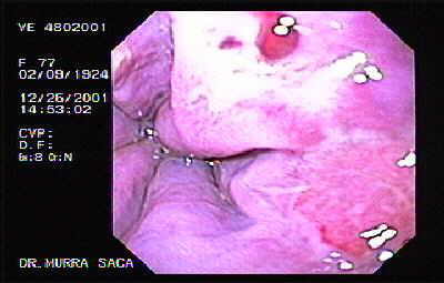 argila cu vene varicoase perioada de recuperare dupa operaie în varicoza